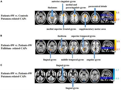 Striatum-related spontaneous coactivation patterns predict treatment response on positive symptoms of drug-naive first-episode schizophrenia with risperidone monotherapy